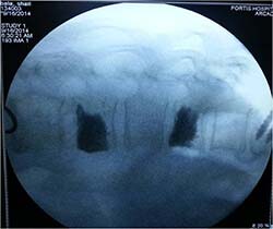 osteoporosis treatment in noida